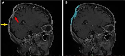 3D-printed Model and guide plate for accurate resection of advanced cutaneous squamous cell carcinomas